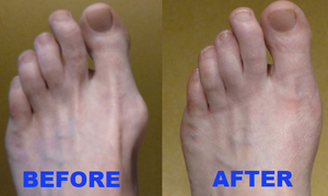 ORTHOPEDIC BUNION CORRECTOR