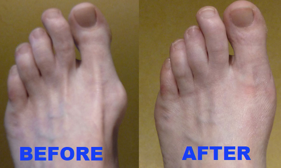 ORTHOPEDIC BUNION CORRECTOR